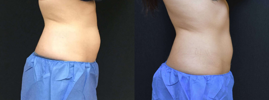 CoolSculpting® Before and After Photo by Versailles Medical Spa in Darien, CT