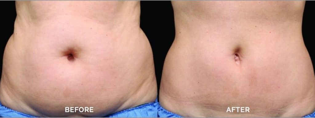 CoolSculpting® Before and After Photo by Versailles Medical Spa in Darien, CT