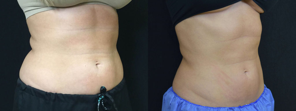 CoolSculpting® Before and After Photo by Versailles Medical Spa in Darien, CT