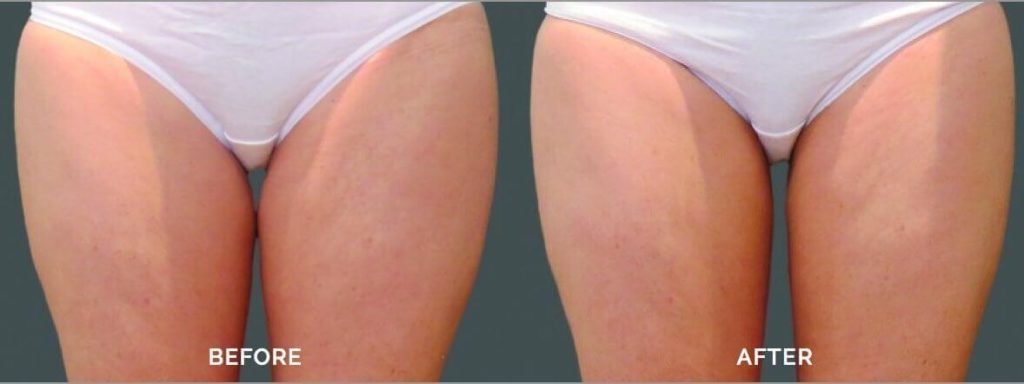 CoolSculpting® Before and After Photo by Versailles Medical Spa in Darien, CT