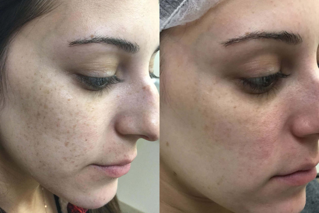 IPL Before and After Photo by Versailles Medical Spa in Darien, CT