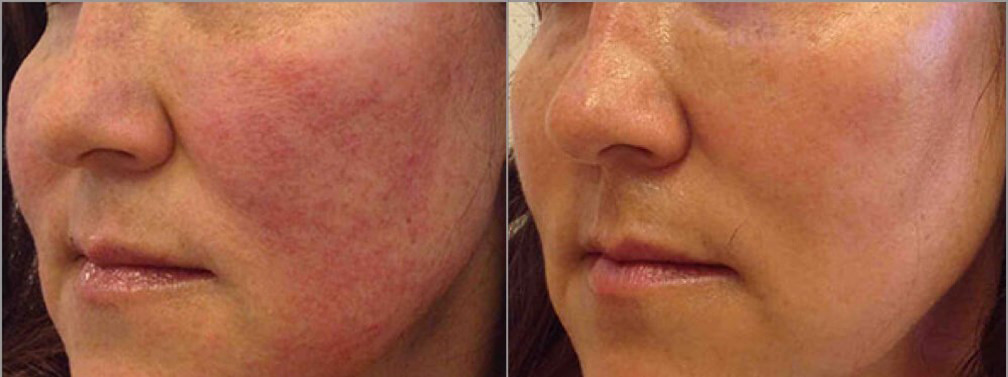 IPL Before and After Photo by Versailles Medical Spa in Darien, CT