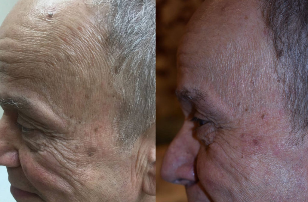IPL Before and After Photo by Versailles Medical Spa in Darien, CT