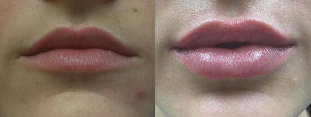 Juvéderm® Before and After Photo by Versailles Medical Spa in Darien, CT