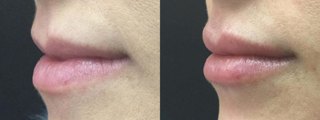 Juvéderm® Before and After Photo by Versailles Medical Spa in Darien, CT