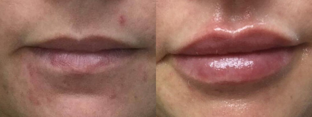 Juvéderm® Before and After Photo by Versailles Medical Spa in Darien, CT