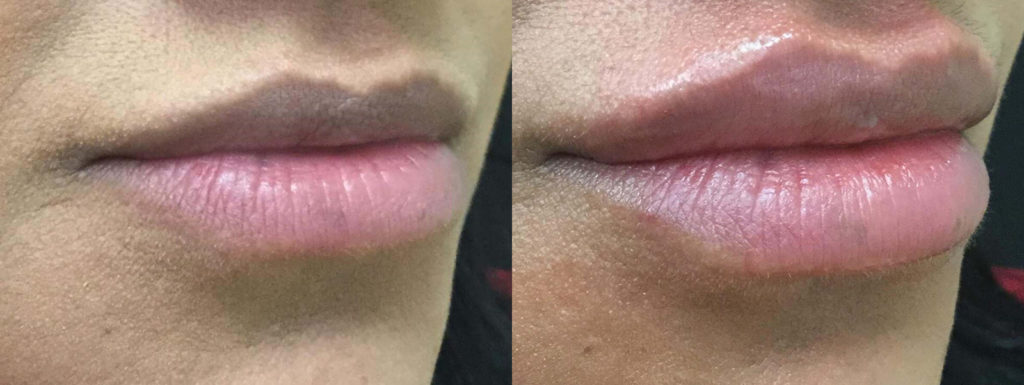 Juvéderm® Before and After Photo by Versailles Medical Spa in Darien, CT