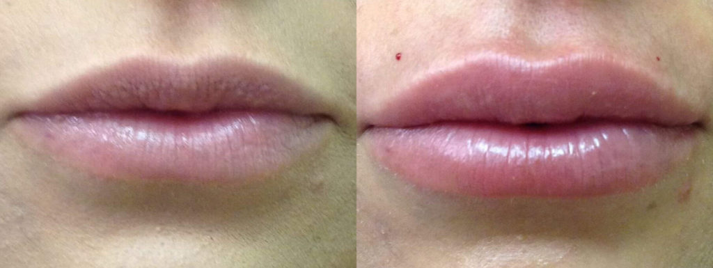 Juvéderm® Before and After Photo by Versailles Medical Spa in Darien, CT