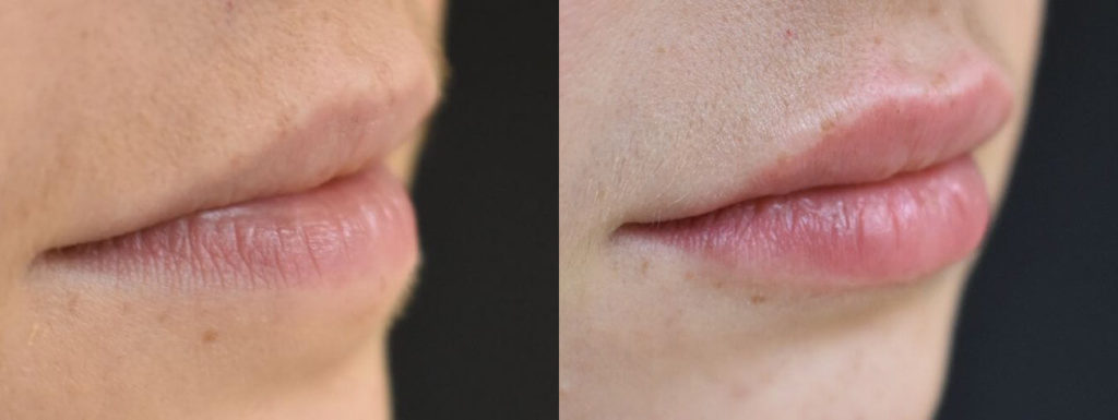Juvéderm® Before and After Photo by Versailles Medical Spa in Darien, CT