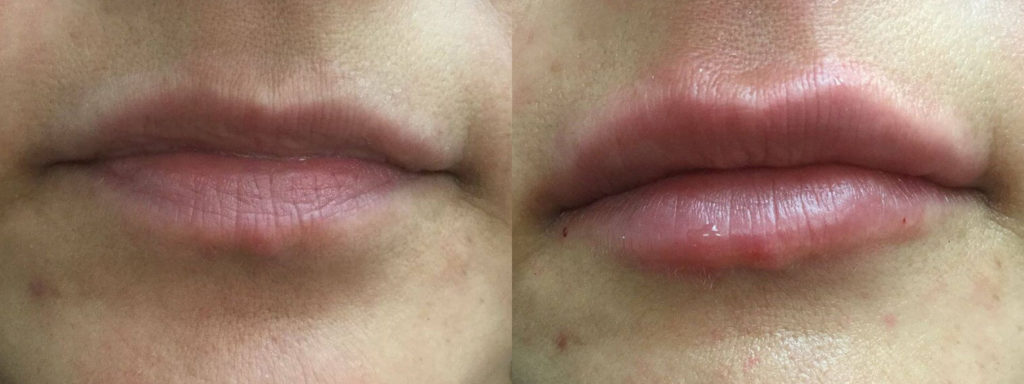 Juvéderm® Before and After Photo by Versailles Medical Spa in Darien, CT