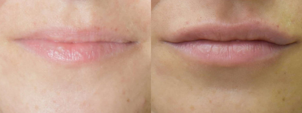 Juvéderm® Before and After Photo by Versailles Medical Spa in Darien, CT