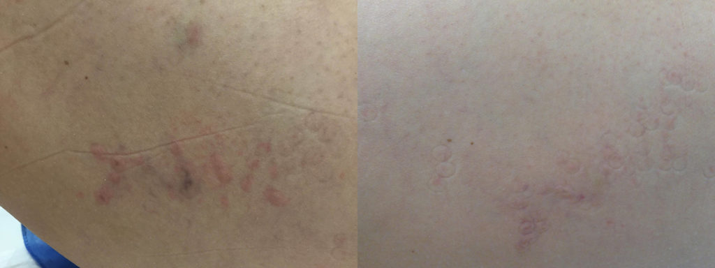 Laser Vein Removal Before and After Photo by Versailles Medical Spa in Darien, CT