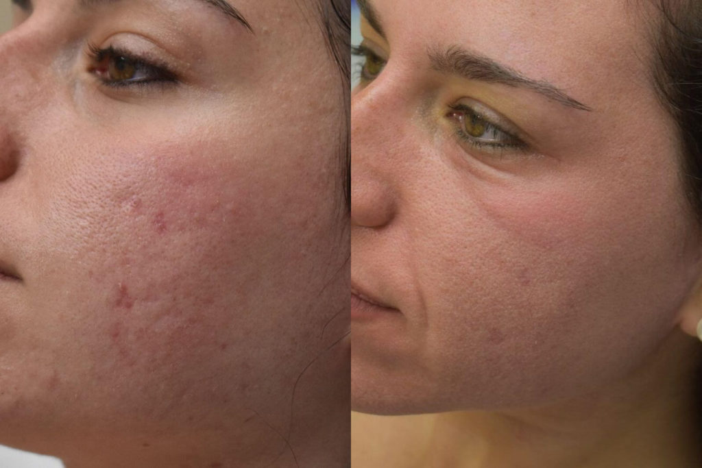 Laser Skin Resurfacing Before and After Photo by Versailles Medical Spa in Darien, CT
