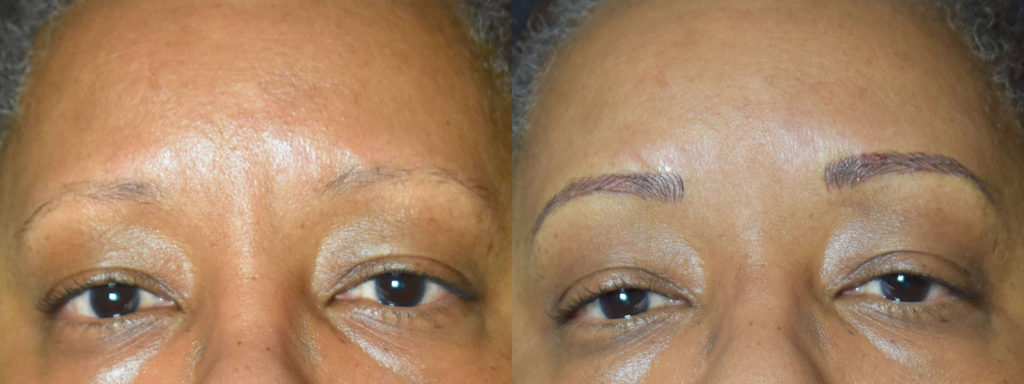 Microblading Before and After Photo by Versailles Medical Spa in Darien, CT