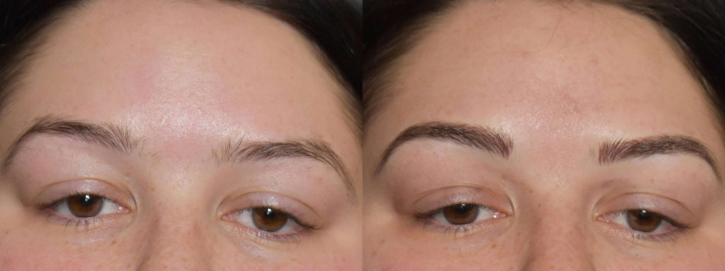 Microblading Before and After Photo by Versailles Medical Spa in Darien, CT