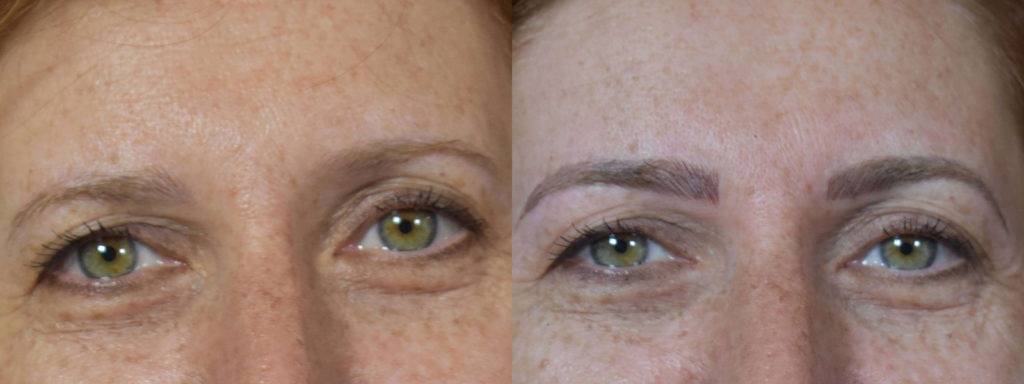 Microblading Before and After Photo by Versailles Medical Spa in Darien, CT