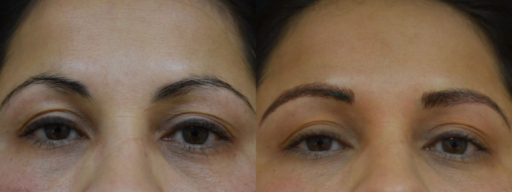 Microblading Before and After Photo by Versailles Medical Spa in Darien, CT