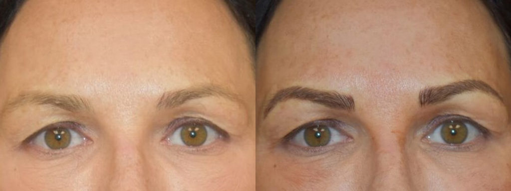 Microblading Before and After Photo by Versailles Medical Spa in Darien, CT