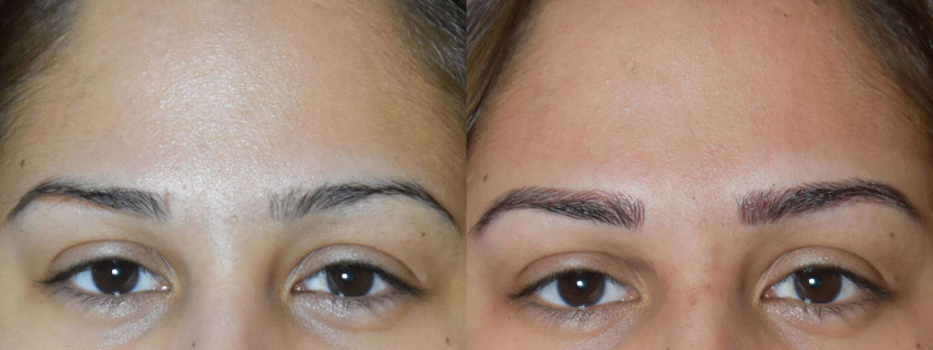 Microblading Before and After Photo by Versailles Medical Spa in Darien, CT