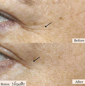 tattoo removal fairfield ct