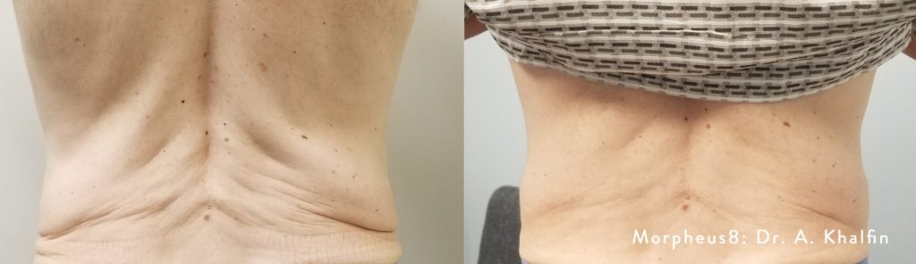 Morpheus8 Before & After Results