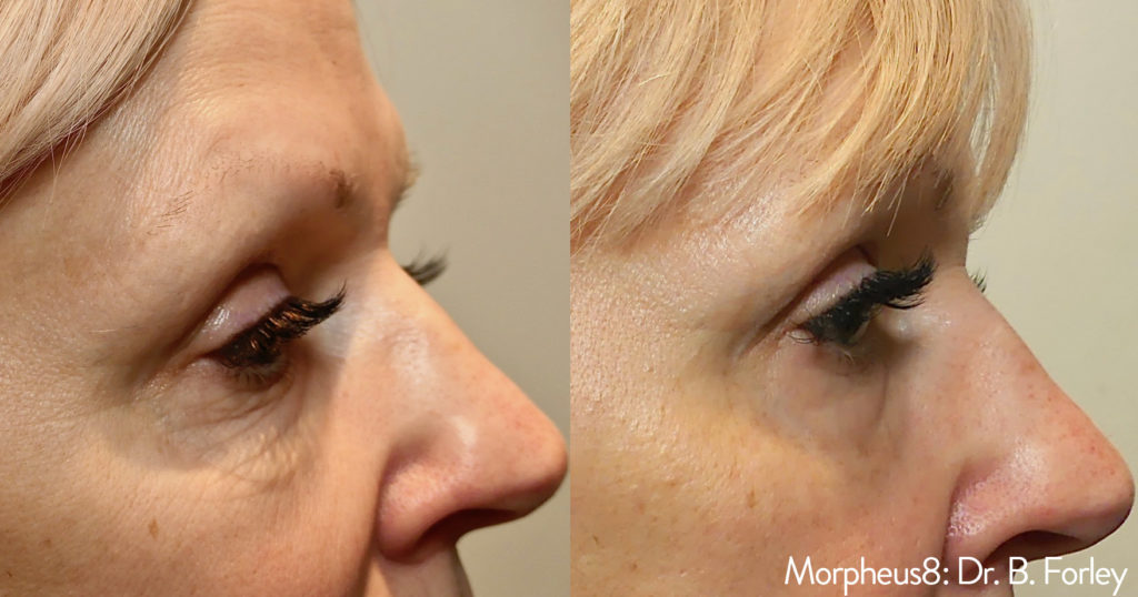 Morpheus8 Before & After Results