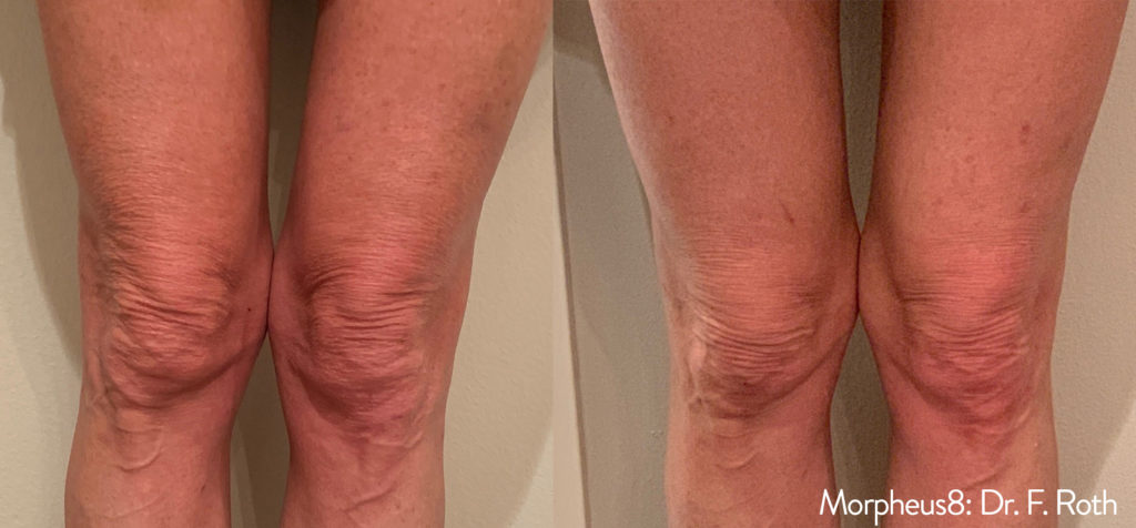Morpheus8 Before & After Results