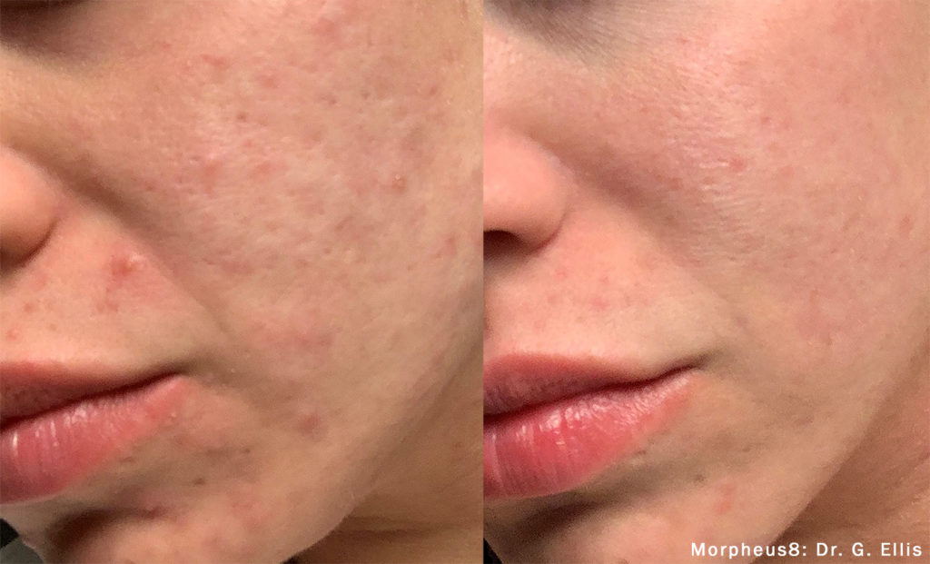 Morpheus8 Before & After Results