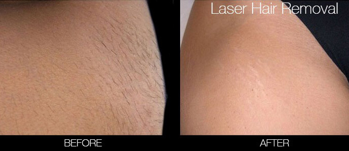 Laser Hair Removal Before and After Results