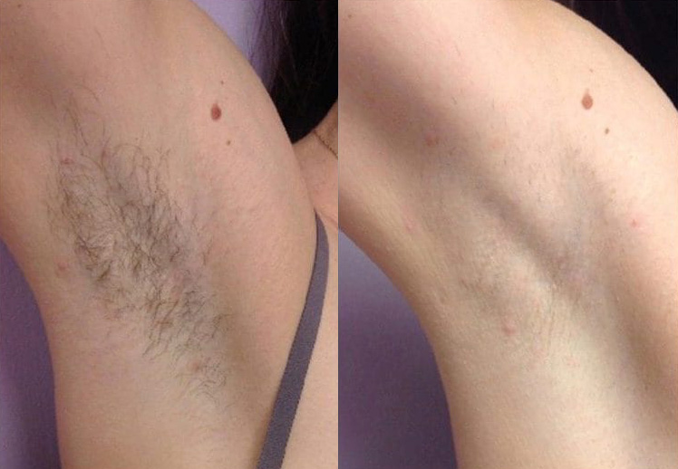 Laser Hair Removal Before and After Results