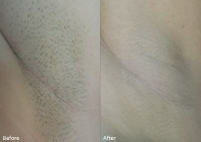 Laser Hair Removal Before and After Results