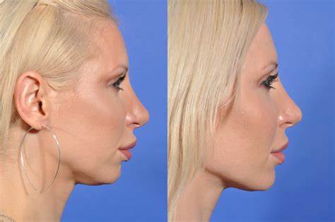Kybella Before and After Results