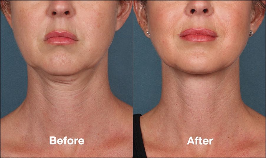 Kybella Before and After Results
