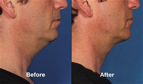 Kybella Before and After Results