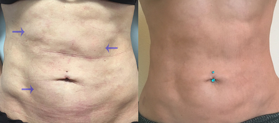 Kybella Before and After Results