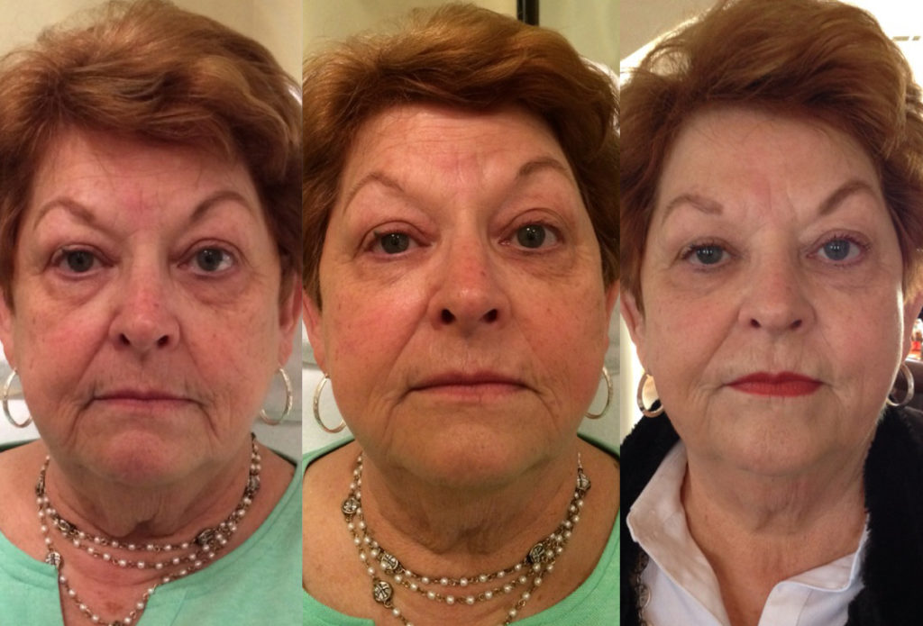 Liquid Face Lift Before and After Results