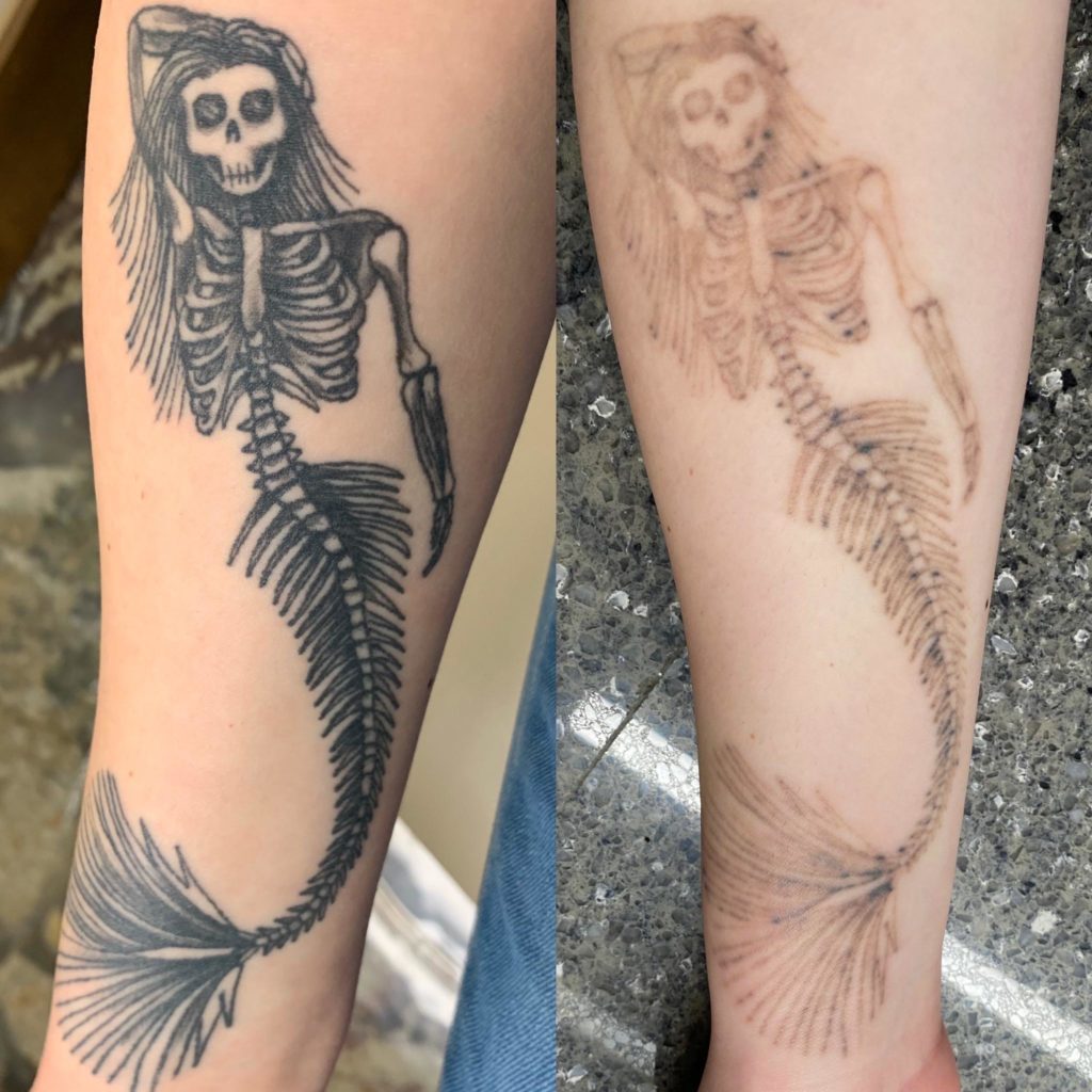 Laser Tattoo Removal Before and After Results
