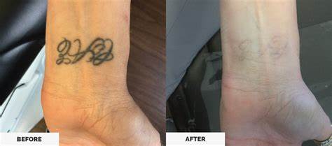 Laser Tattoo Removal Before and After Results