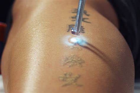Laser Tattoo Removal Before and After Results