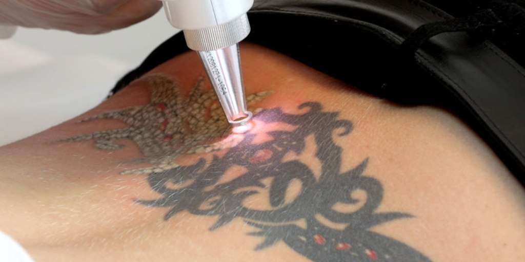 Laser Tattoo Removal Before and After Results