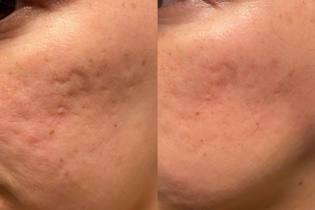 Microneedling Before and After Results