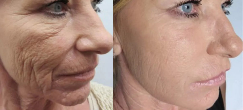 Microneedling Before and After Results