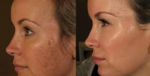 PRP Therapy Before and After Results