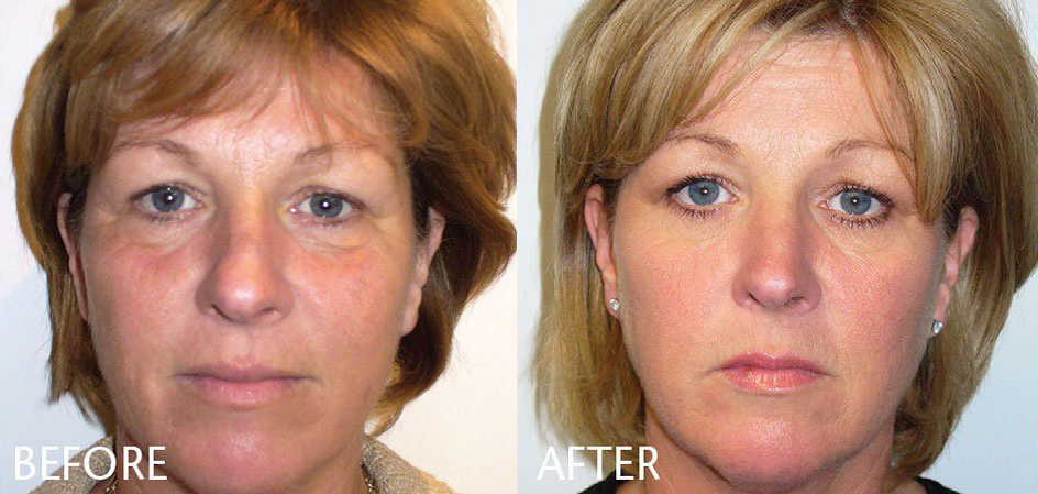 PRP Therapy Before and After Results