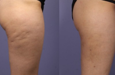 QWO Before and After Results