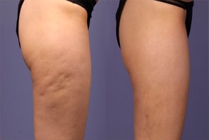 QWO Before and After Results