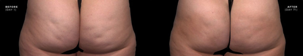 QWO Before and After Results
