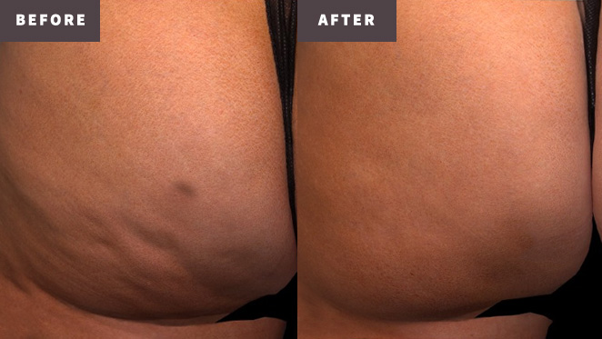 QWO Before and After Results