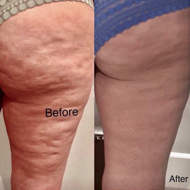 QWO Before and After Results