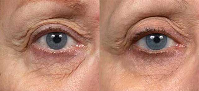 Thermage Before and After Results